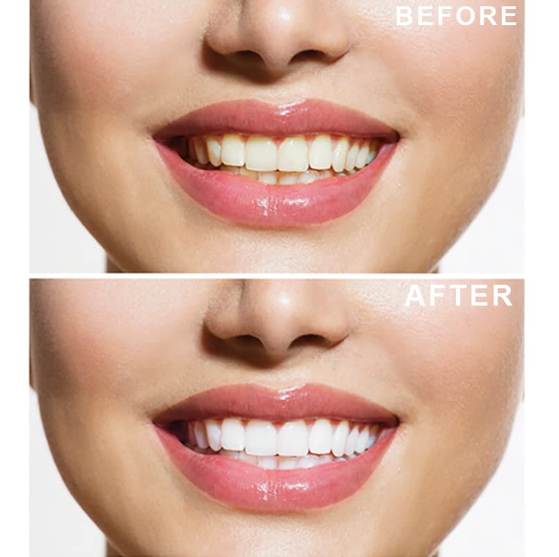 8 Gel Teeth Whitening Kit & 7 Deluxe Strips - Ultimate Kit - Crystal Whites