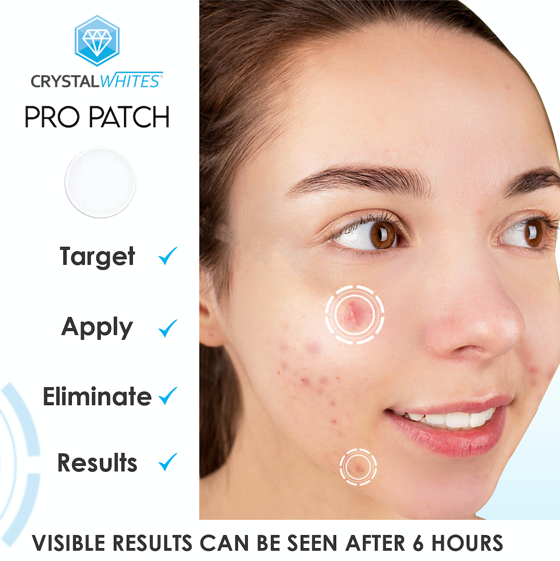 36 Pimple Pro Patches for spots, acne and blemishes - Crystal Whites