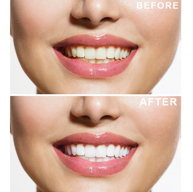 LED Teeth Whitening Activator Light - Crystal Whites