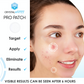144 Pimple Pro Patches for spots, acne and blemishes